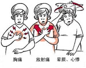 冠心病有哪些癥狀？(圖1)