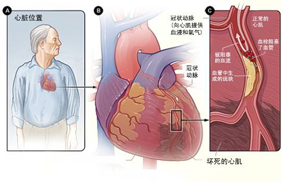 怎樣治療冠心??？(圖3)
